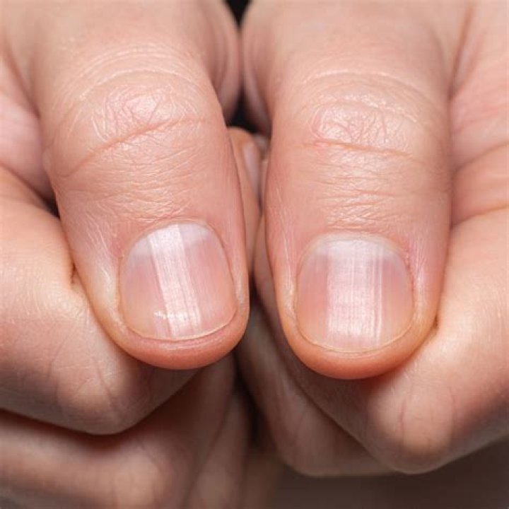 Can diabetes affect your nails?