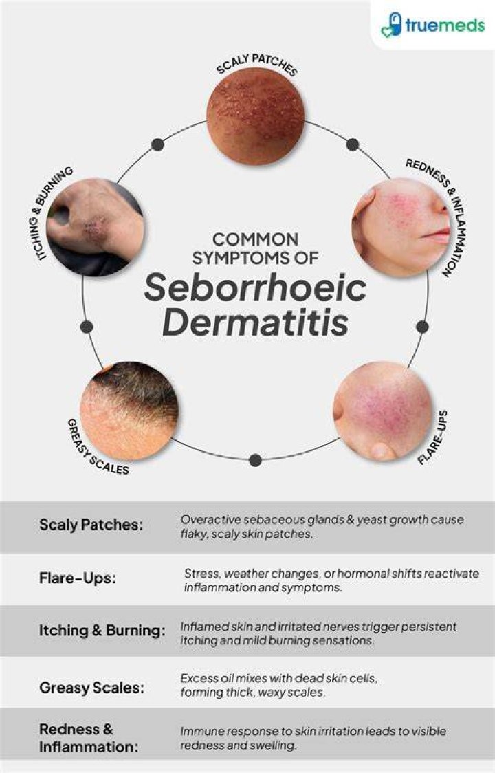 Can dry skin cause seborrheic dermatitis?