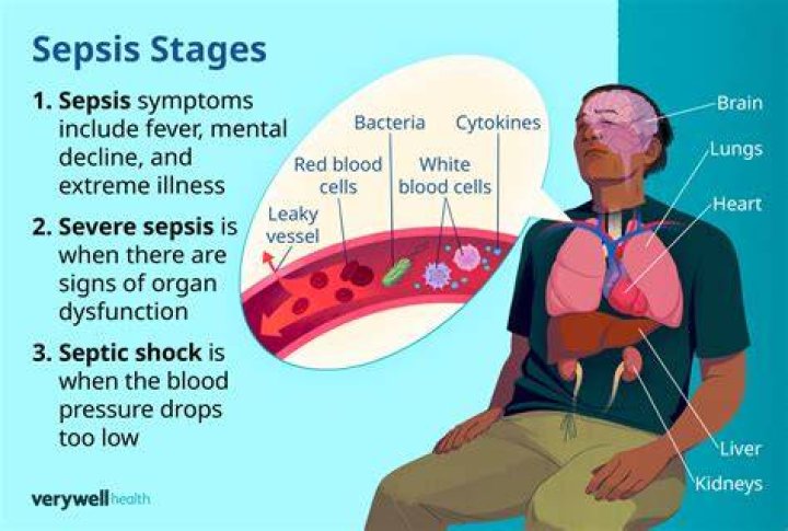 Can eczema turn into sepsis?