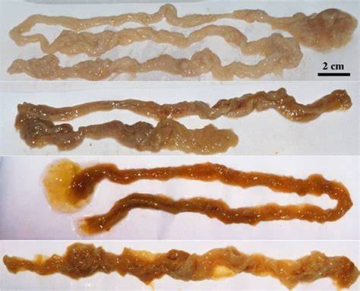 Can food look like worms in stool?