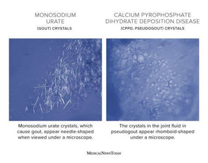 Can gout crystals be dissolved?