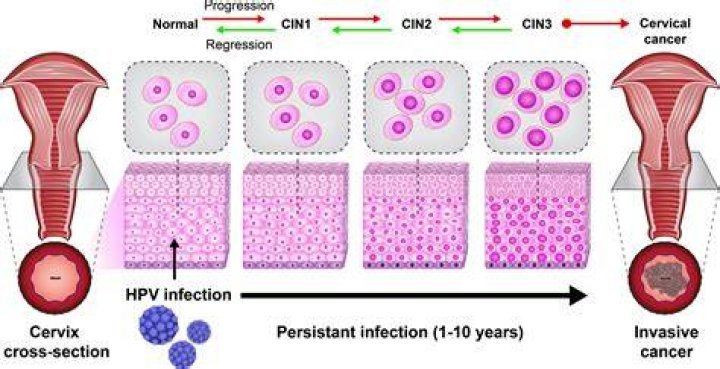 Can HPV cells be removed?