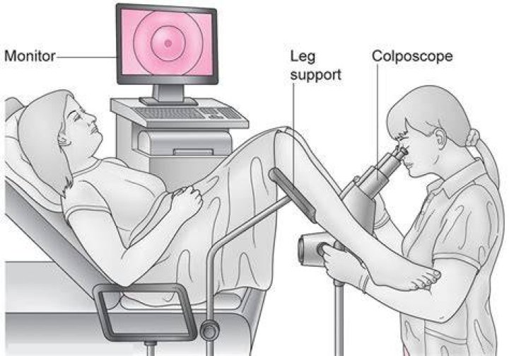 Can HPV come back after colposcopy?