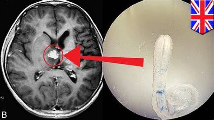 Can humans get brain worm?