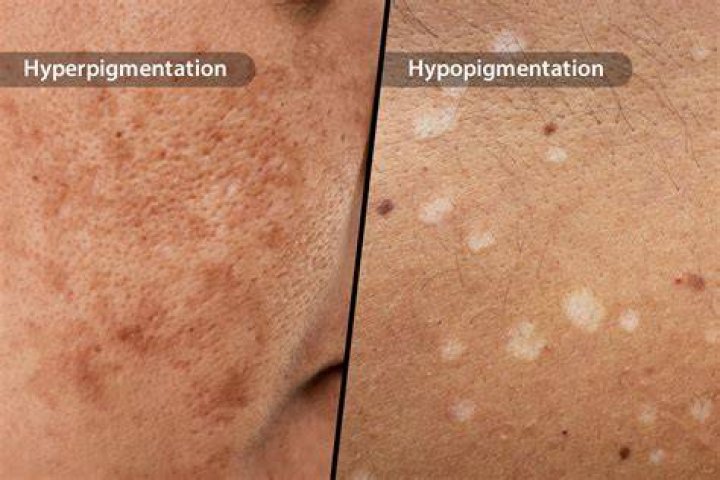 Can hypopigmentation be cured?