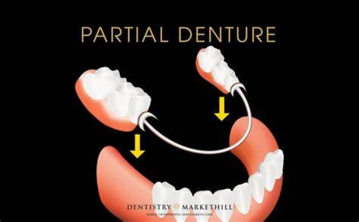 Can I get a partial denture with no back teeth?