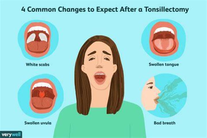 Can I hit my Juul after tonsillectomy?
