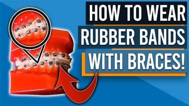 Can I just wear rubber bands at night?