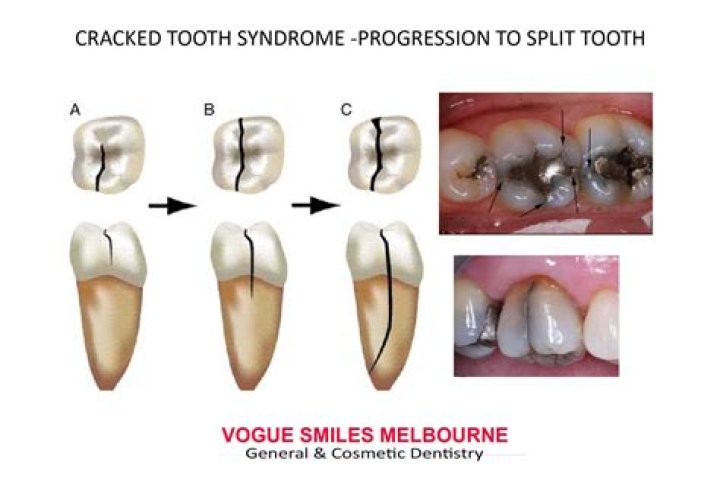 Can I wait a week with a cracked tooth?