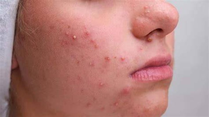 Can jaggery cause pimples?