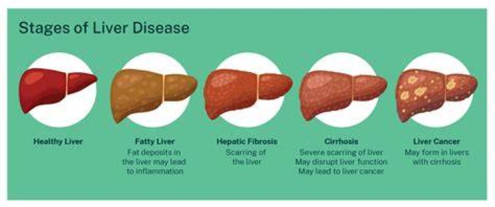 Can liver problems make you gain weight?