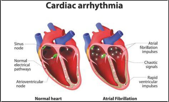 Can magnesium cause arrhythmia?