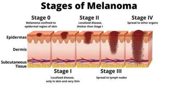 Can melanoma spread after being removed?