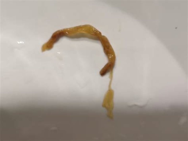 Can mucus look like worms?