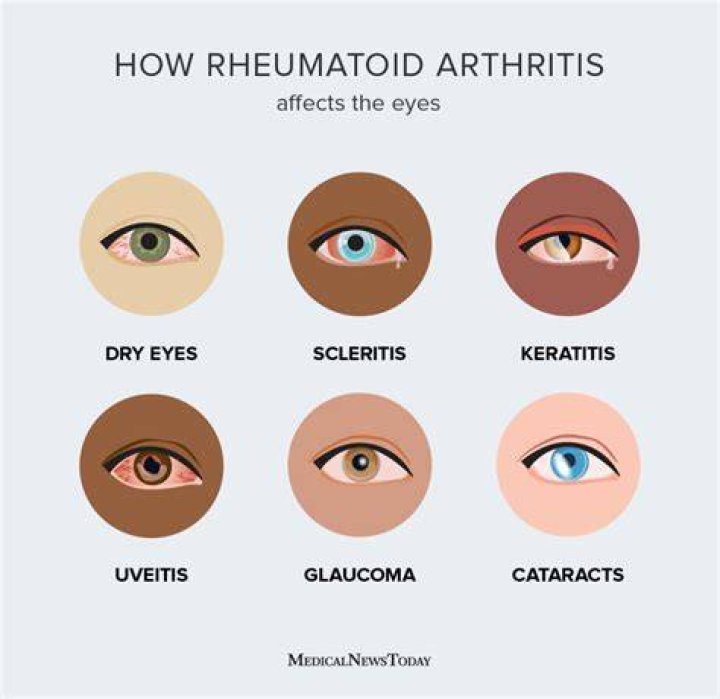 Can rheumatoid arthritis affect your face?