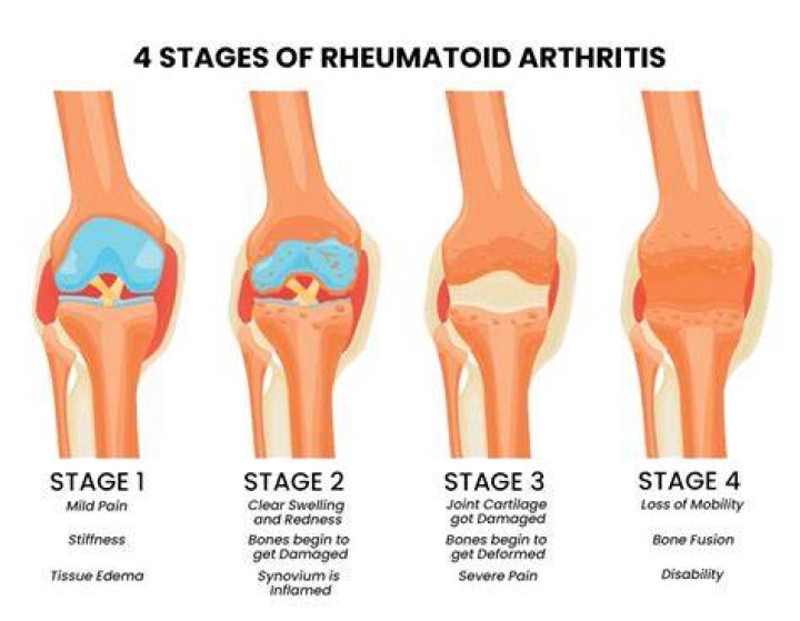 Can rheumatoid arthritis be cured at early stages?