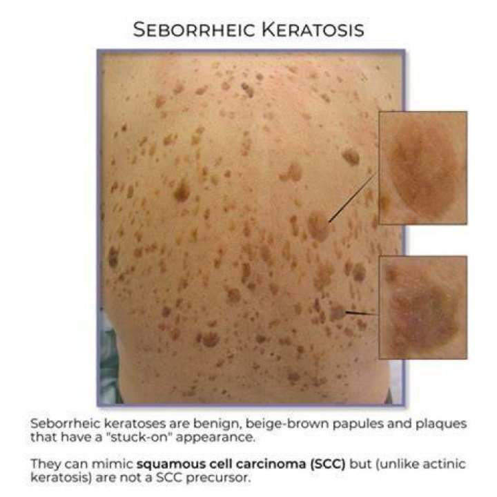 Can seborrheic keratosis have dark spots?