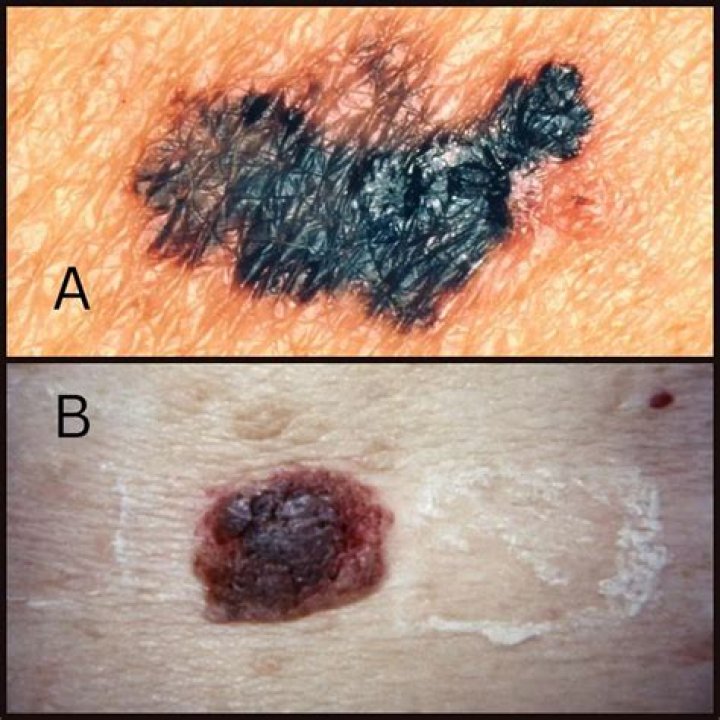 Can seborrheic keratosis look like melanoma?