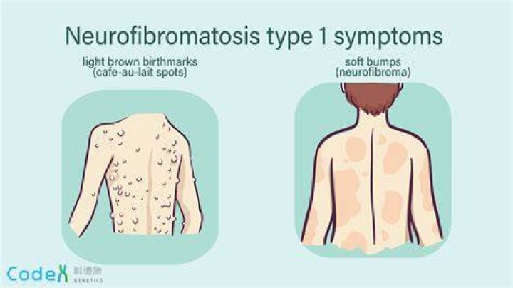 Can someone with neurofibromatosis have kids?