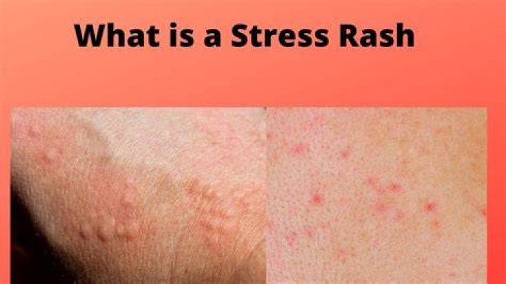 Can stress cause itching at night?