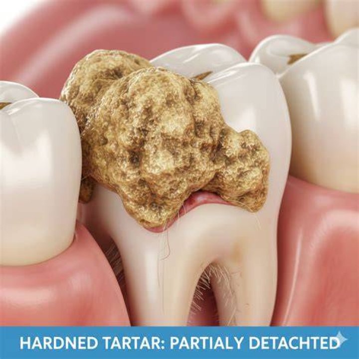 Can tartar chip off?