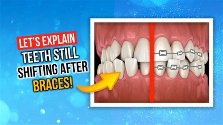 Can teeth shift in hours?