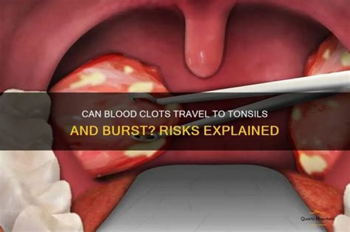Can tonsils burst?