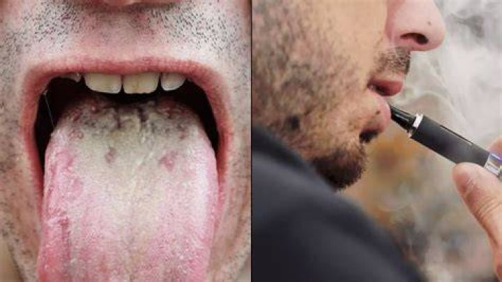 Can vaping crack your tongue?