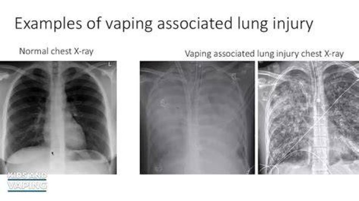 Can vaping show up on xray?