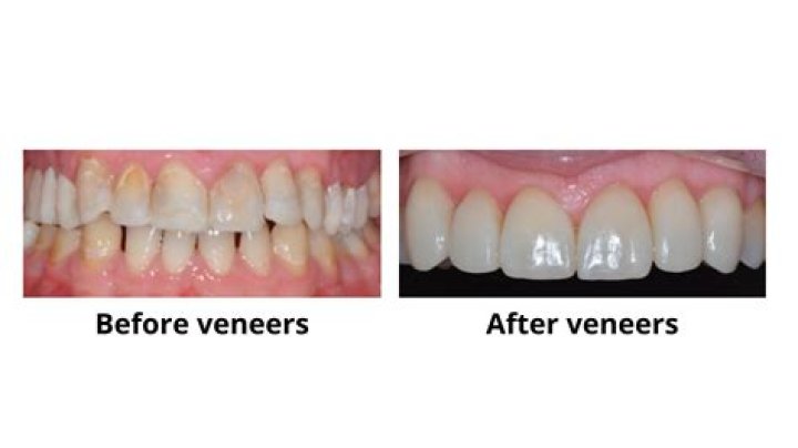 Can veneers wear down?