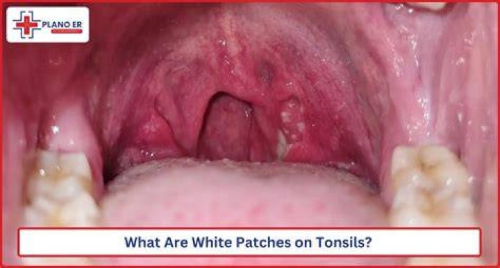 Can viruses cause white patches in throat?
