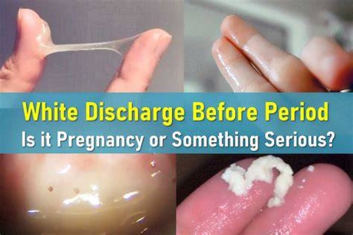 Can white discharge cause AIDS?