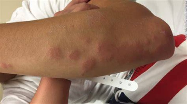 Can you become immune to bed bug bites?
