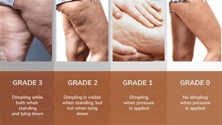 Can you break up cellulite?