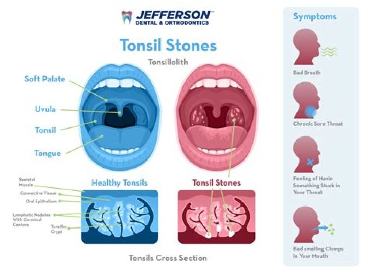 Can you cough out tonsil stones?