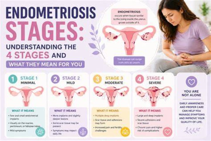 Can you develop endometriosis at any age?