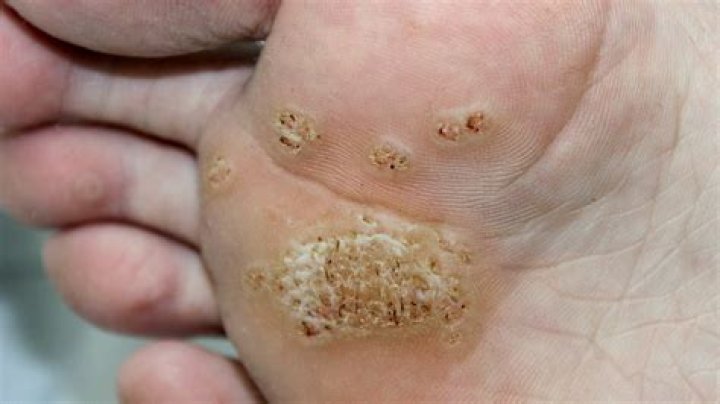Can you dig out a wart?