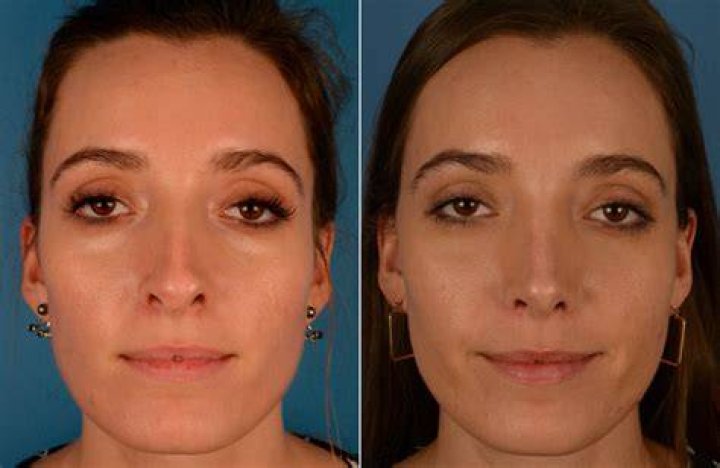 Can you do rhinoplasty during period?