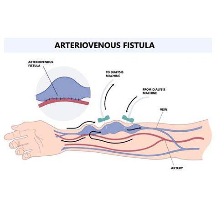 Can you feel a fistula with your finger?