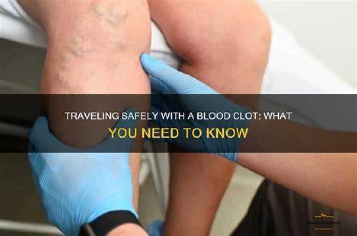 Can you feel a traveling blood clot?