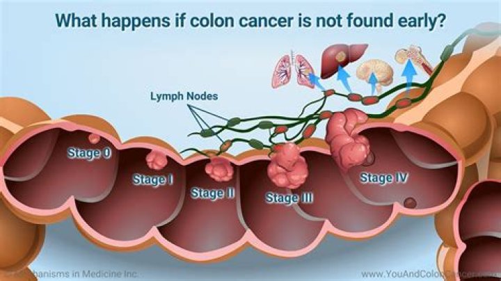 Can you feel a tumor in your colon?