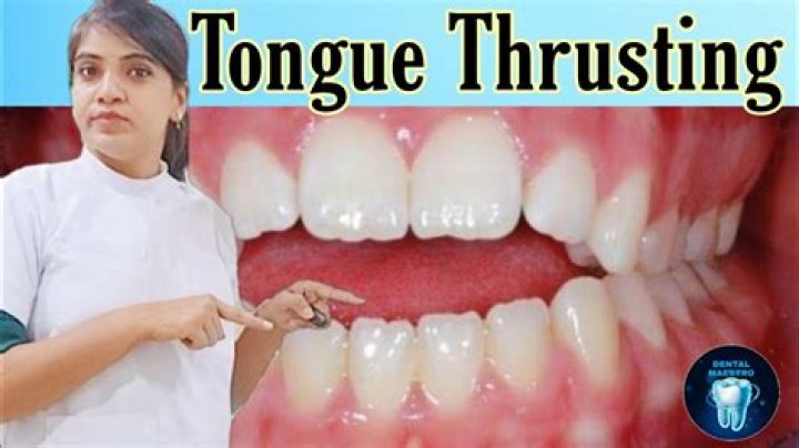 Can you fix tongue thrust?