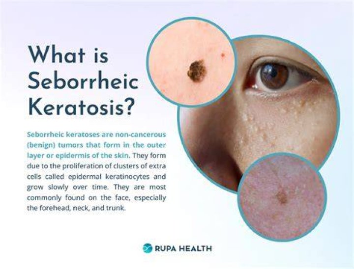 Can you freeze seborrheic keratosis at home?