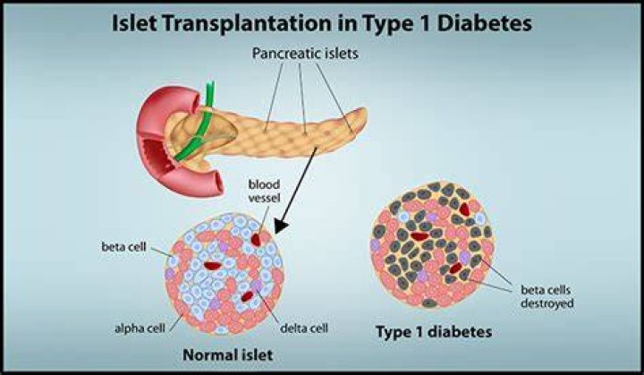 Can you get a pancreas transplant for type 1 diabetes?