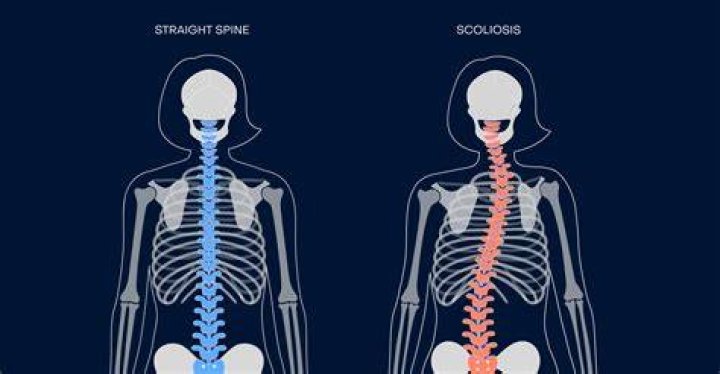 Can you get a scholarship for having scoliosis?