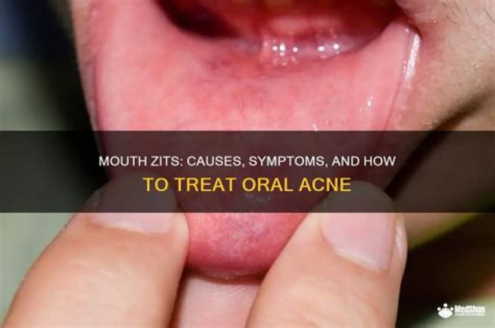 Can you get a zit inside your mouth?