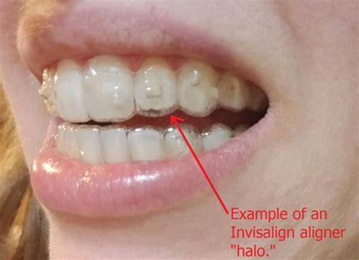 Can you get cavities filled with Invisalign?