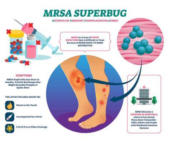 Can you get MRSA on your feet?