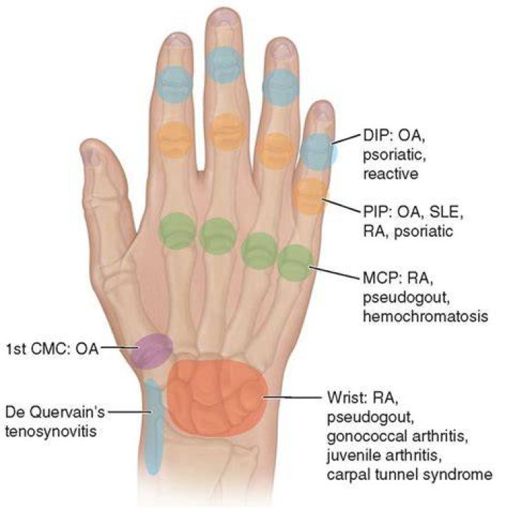 Can you get PIP for osteoarthritis?