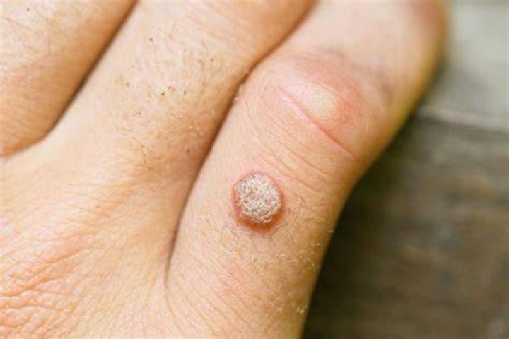 Can you get warts by holding hands?